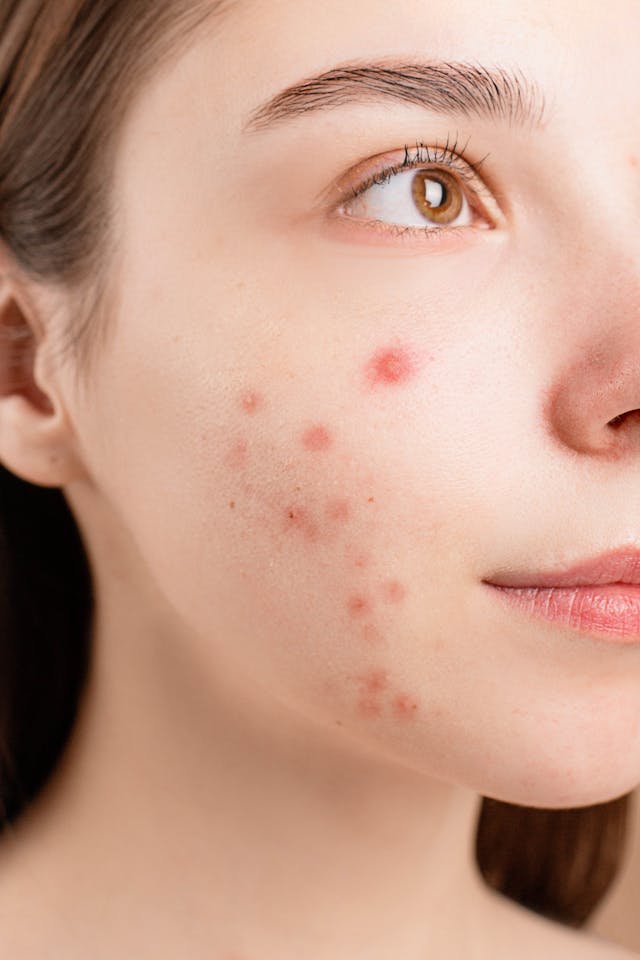 Read more about the article Acne Symptoms and Treatment: Mystery of Acne