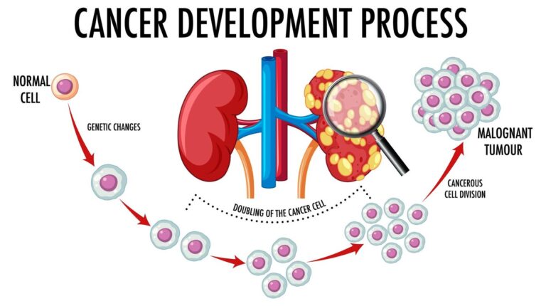 Read more about the article Kidney Cancer Symptoms & Treatment